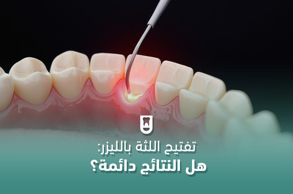 تفتيح اللثة بالليزر: هل النتائج دائمة؟ دليل شامل لكل ما تحتاج معرفته