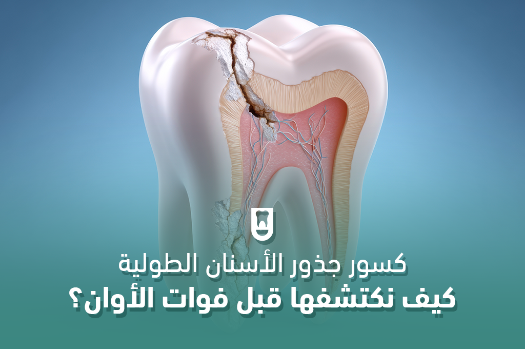 كسور جذور الأسنان الطولية: كيف نكتشفها قبل فوات الأوان؟