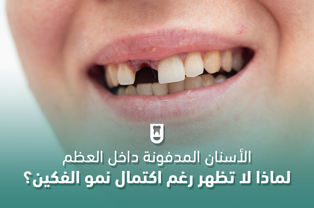 الأسنان المدفونة داخل العظم: لماذا لا تظهر رغم اكتمال نمو الفكين؟