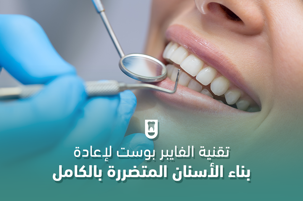 تقنية الفايبر بوست لإعادة بناء الأسنان المتضررة بالكامل