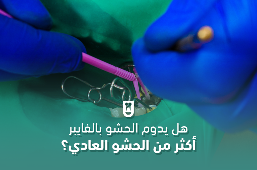 هل يدوم الحشو بالفايبر أكثر من الحشو العادي؟