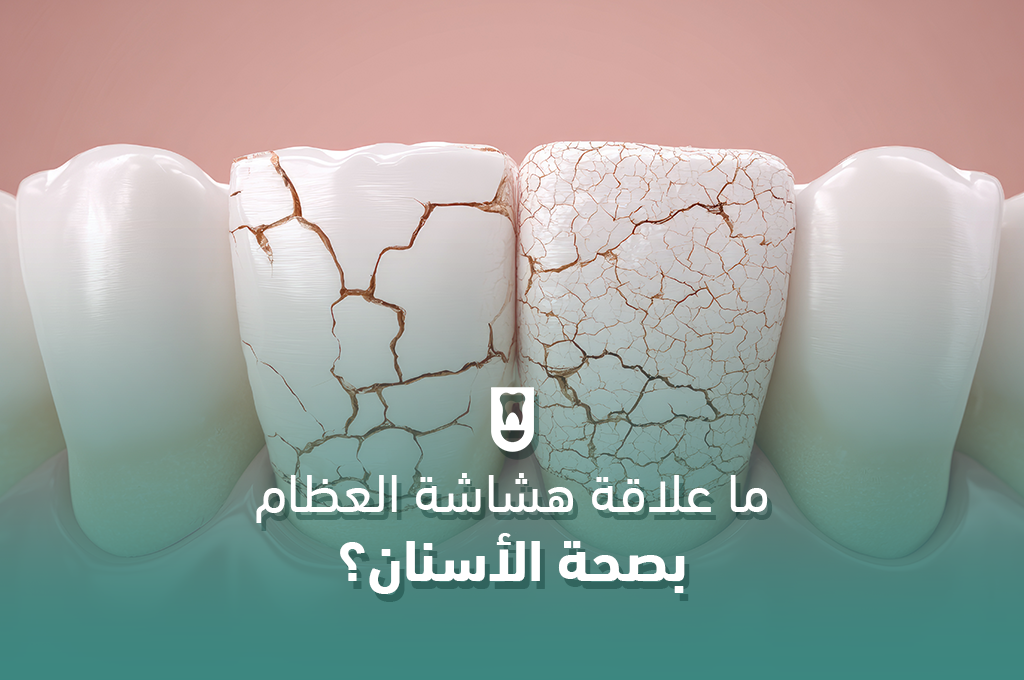 ما علاقة هشاشة العظام بصحة الأسنان؟