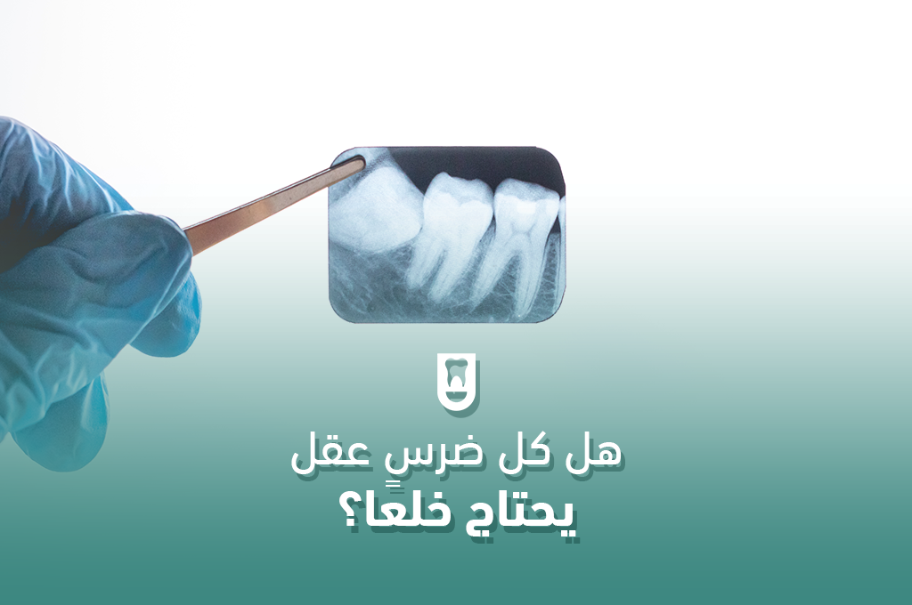 هل كل ضرس عقل يحتاج خلعًا؟ دليل شامل