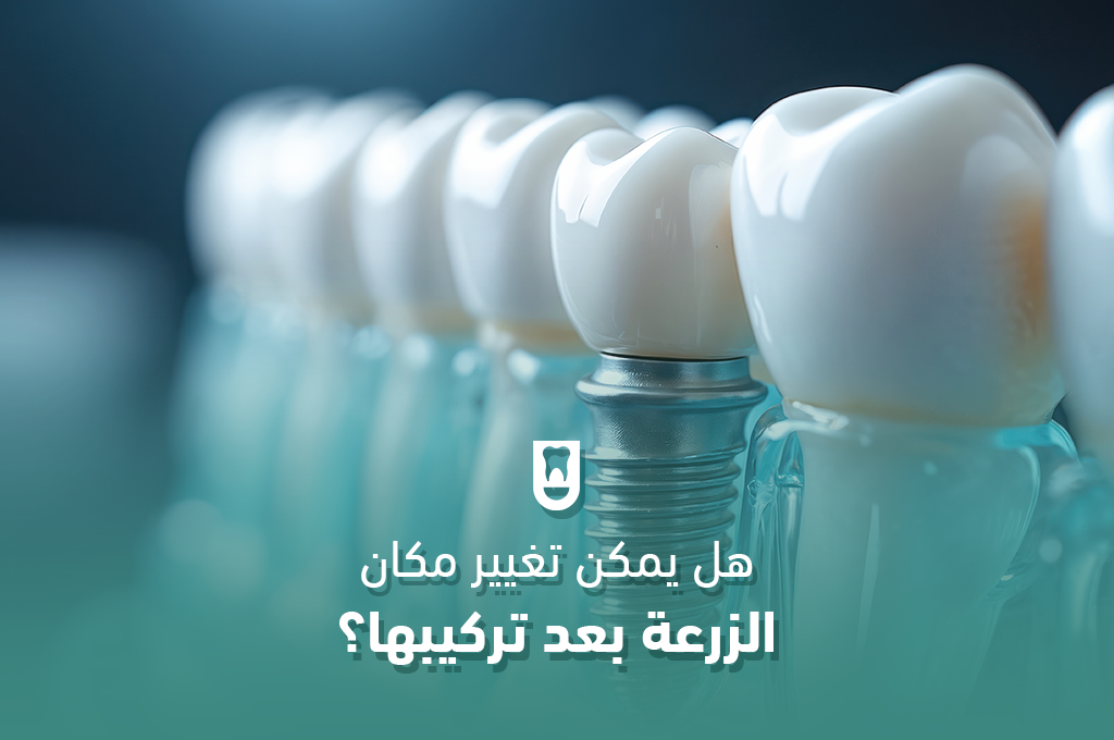 هل يمكن تغيير مكان الزرعة بعد تركيبها؟