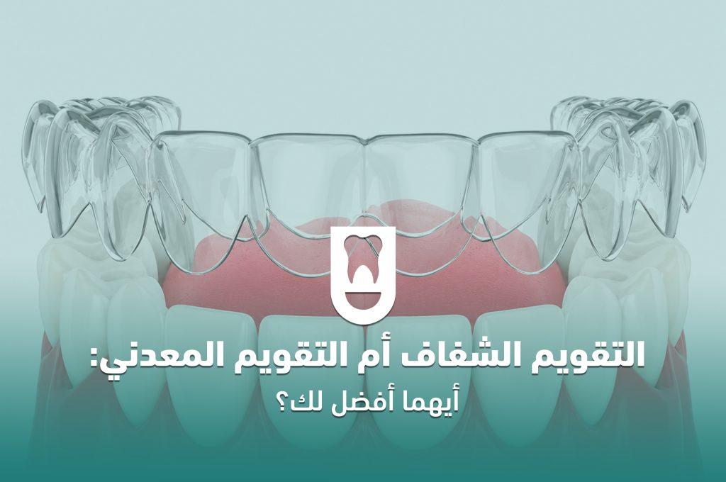 التقويم الشفاف أم التقويم المعدني: أيهما أفضل لك؟