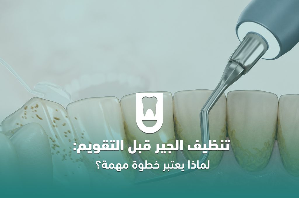 تنظيف الجير قبل التقويم: لماذا يعتبر خطوة مهمة؟