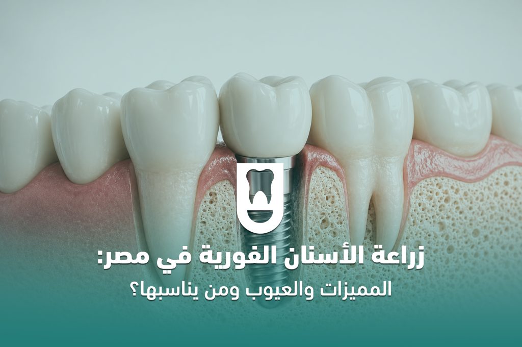 زراعة الأسنان الفورية في مصر: المميزات والعيوب ومن يناسبها؟
