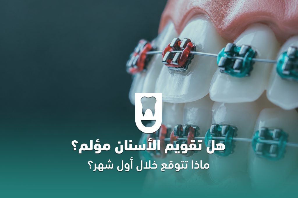 هل تقويم الأسنان مؤلم؟ ماذا تتوقع خلال أول شهر؟