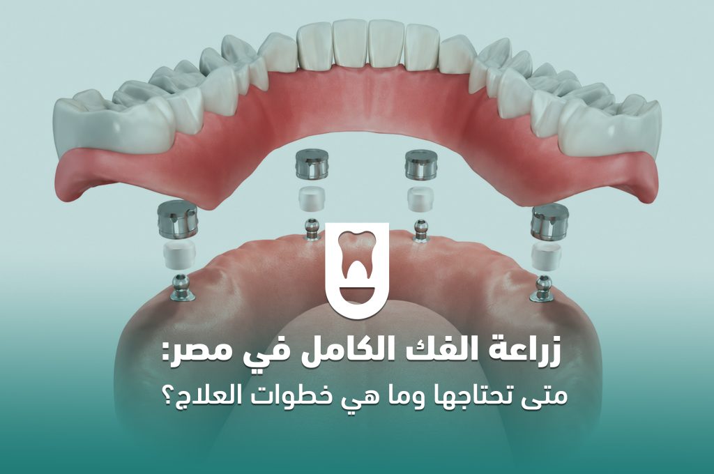 زراعة الفك الكامل في مصر: متى تحتاجها وما هي خطوات العلاج؟