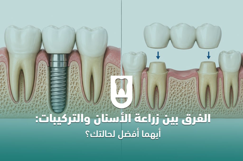 الفرق بين زراعة الأسنان والتركيبات: أيهما أفضل لحالتك؟