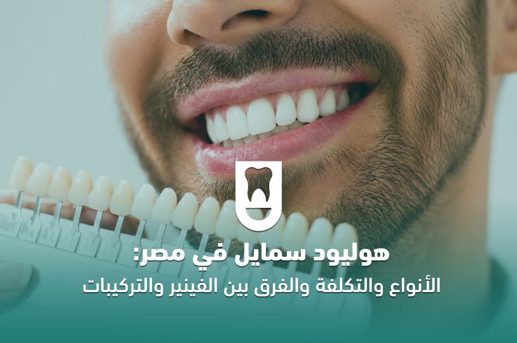 هوليود سمايل في مصر: الأنواع والتكلفة والفرق بين الفينير والتركيبات