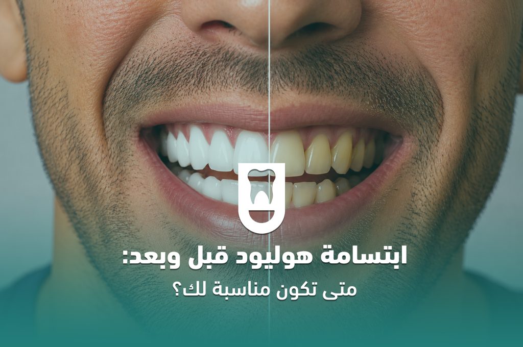 ابتسامة هوليود قبل وبعد: متى تكون مناسبة لك؟