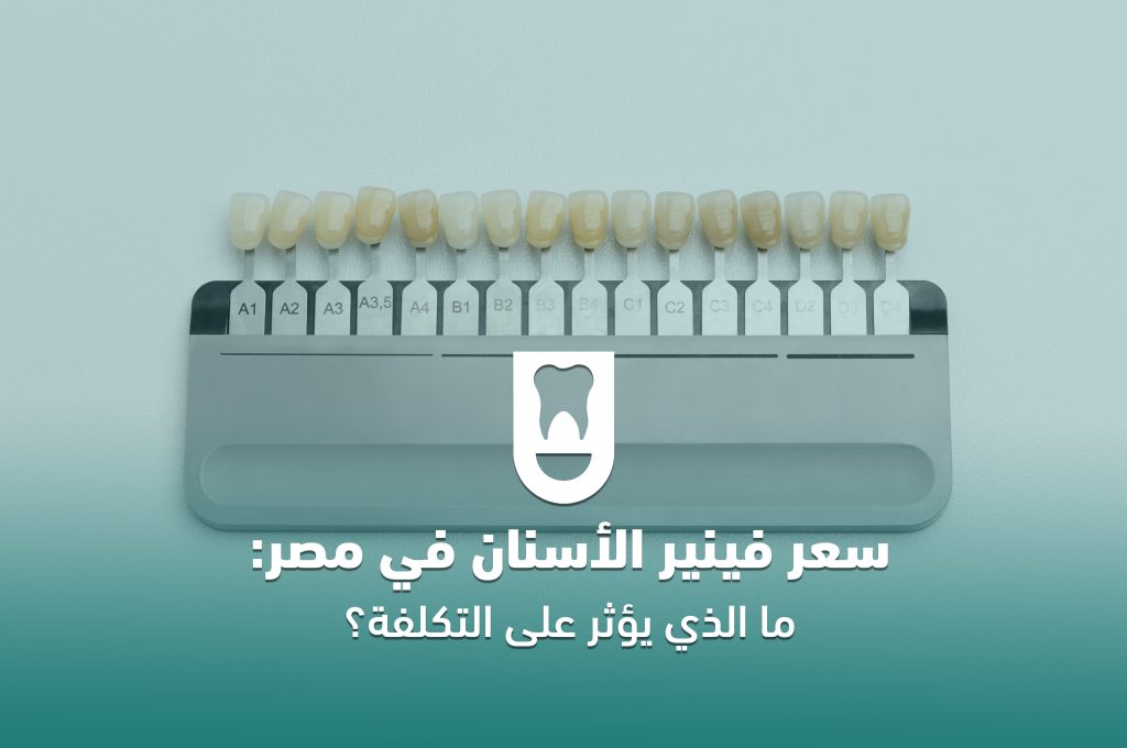سعر فينير الأسنان في مصر: ما الذي يؤثر على التكلفة؟